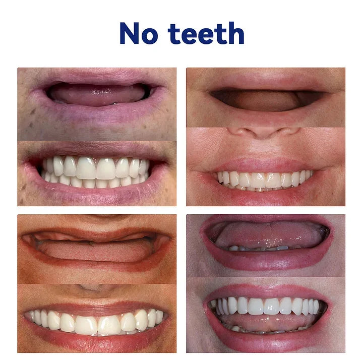 Blizkox™-🦷Advanced Customized Full Denture Set – For a Perfect Smile and Natural Comfort🥰( 🔥Last Day Promotion🔥)