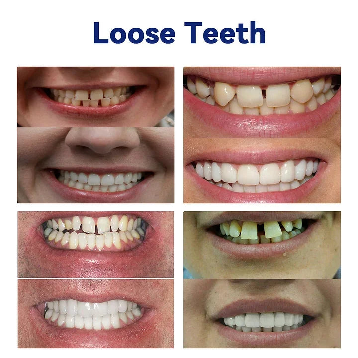 Blizkox™-🦷Advanced Customized Full Denture Set – For a Perfect Smile and Natural Comfort🥰( 🔥Last Day Promotion🔥）