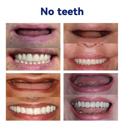 Blizkox™-🦷Advanced Customized Full Denture Set – For a Perfect Smile and Natural Comfort🥰( 🔥Last Day Promotion🔥）